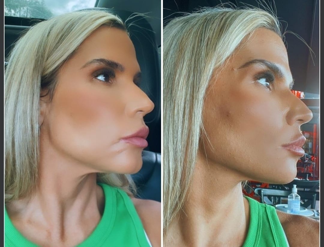 Taty Zatto faz novo procedimento estético no rosto; veja o antes e o depois Taty Zatto faz novo procedimento estético no rosto; veja o antes e o depois