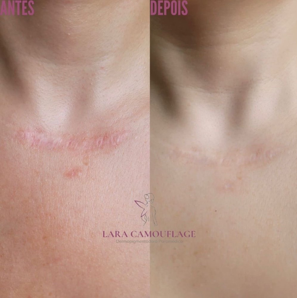 Lara Ferreira: A Revolução na Camuflagem de Cicatrizes, Manchas e estrias 24 08bb8528 f0ca 4f3b 9af9 34dea148f26e 1