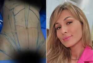Lívia Andrade revela ter feito Lipoaspiração: Entenda os diferentes métodos e resultados