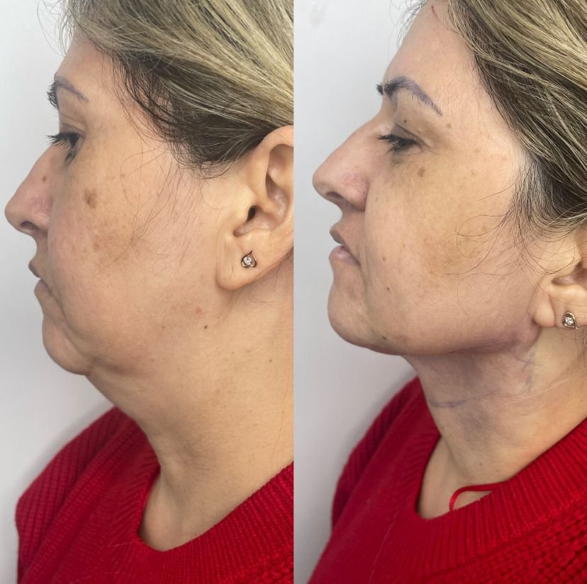 Dr. Lopez explica tudo sobre Lipo de Papada e Harmonização Facial 33 PHOTO 2025 03 11 02 21 26