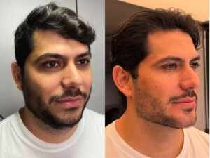 Mirela Janis exibe harmonização facial de Yugnir Ângelo e casal diverte web com vídeo de antes e depois