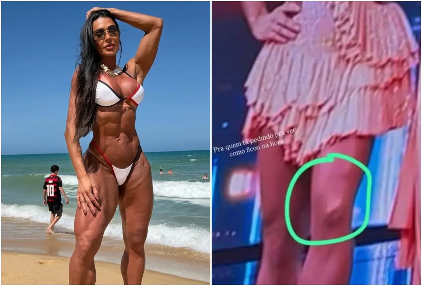 Gracyanne Barbosa detalha recuperação após lesão e revela desafios seis meses depois