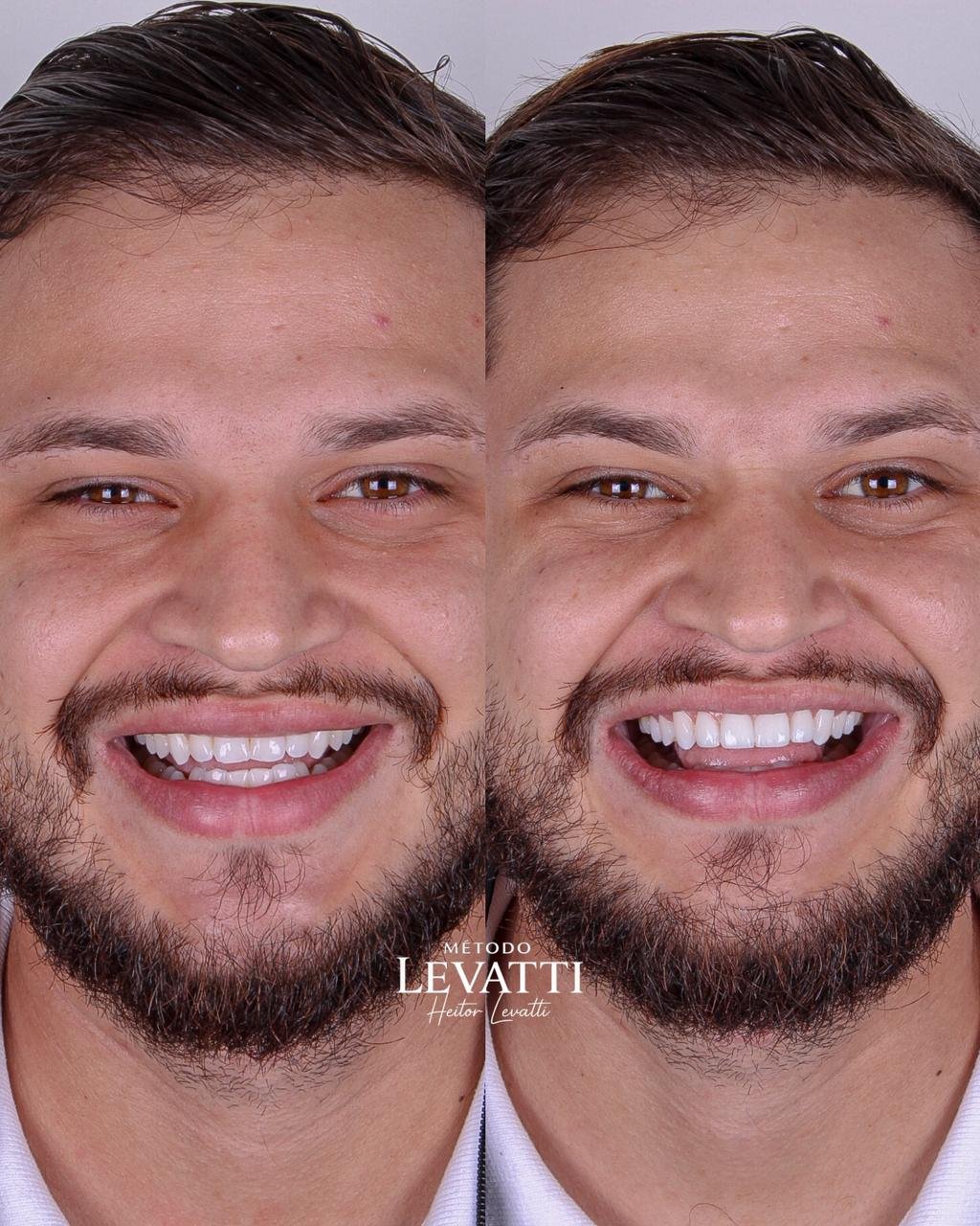 Dr. Heitor Levatti: o nome por trás dos sorrisos exclusivos que vêm conquistando São Paulo 32 a0cdcdb8 6f35 4643 8194 2c559cf7195a